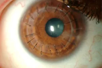Corneal Transplantation Dalk