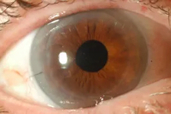 Corneal Transplantation Desk Dmek