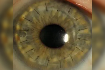 Corneal Transplantation PKP