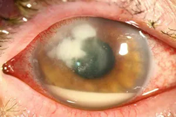 Corneal Infection
