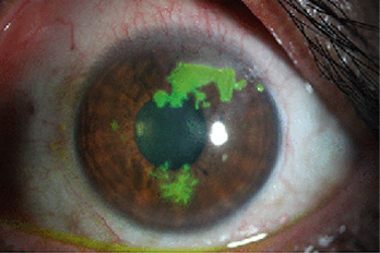 Herpetic Corneal Infection