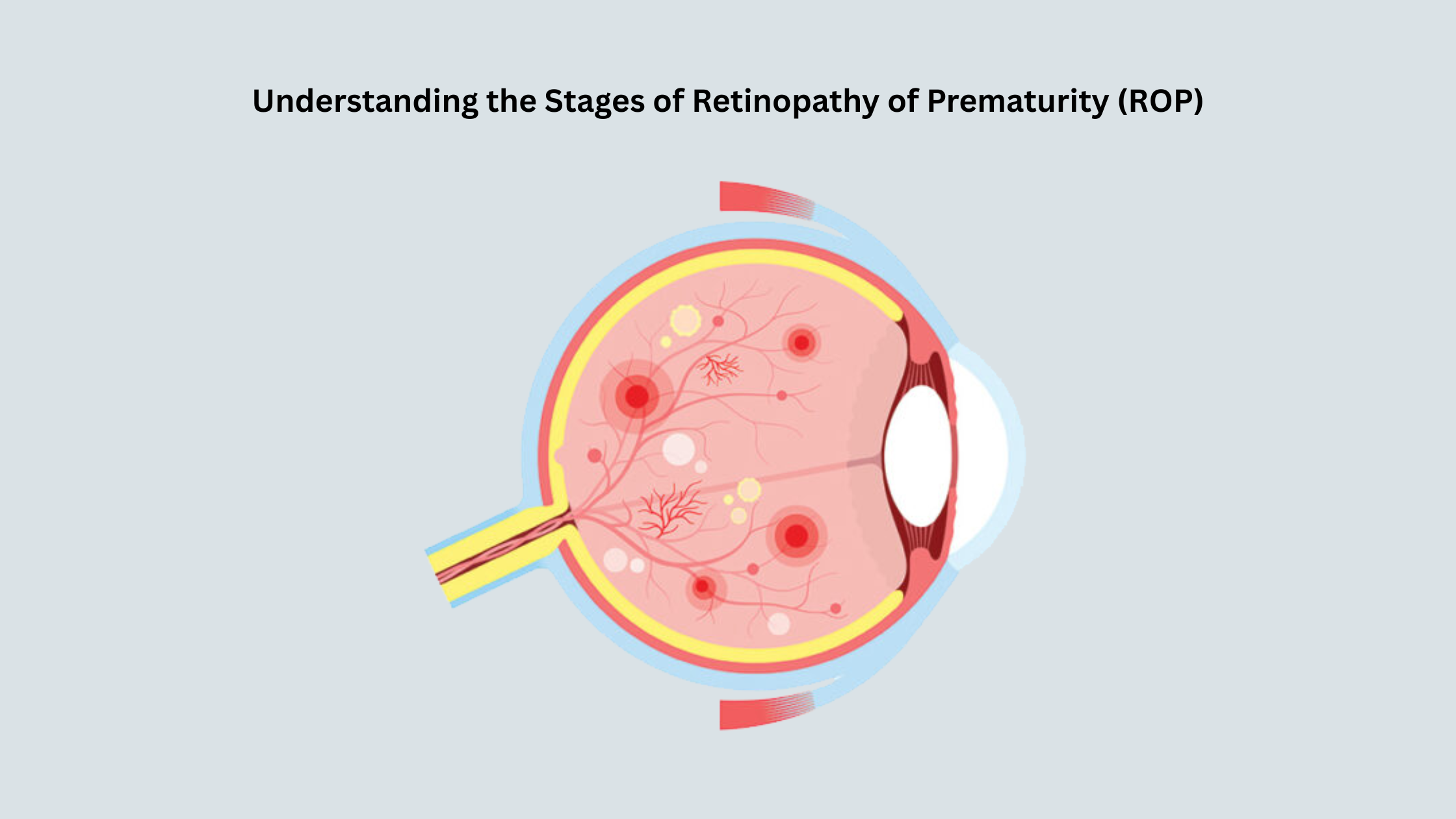 Retinopathy of Prematurity