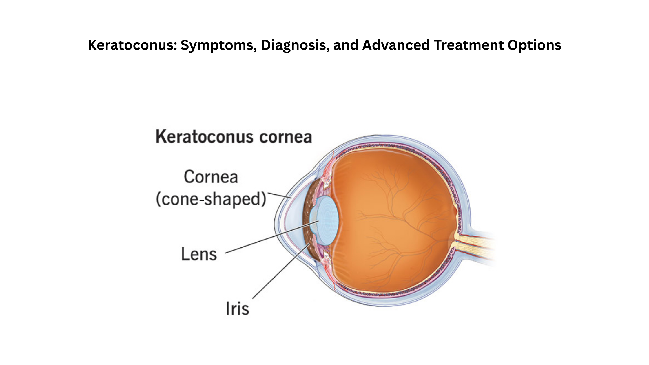 keratoconus
