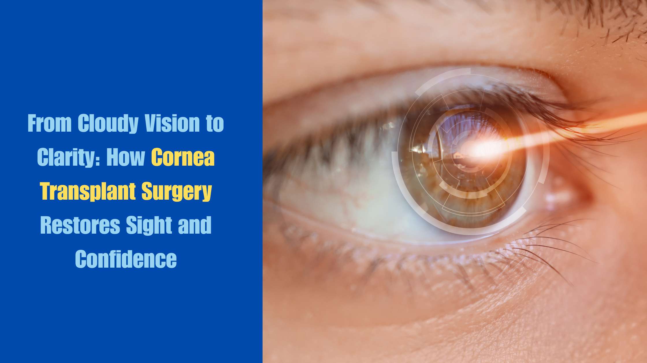 Cornea Transplant Surgery