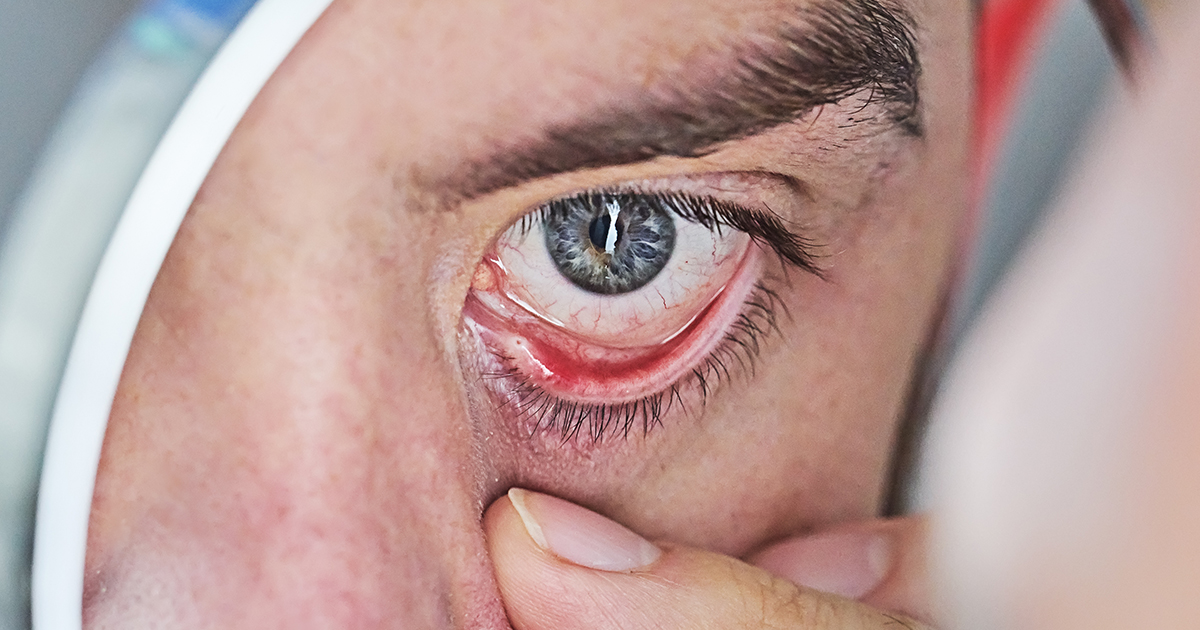 Diabetic Retinopathy